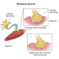 Ilustración de miastenia grave